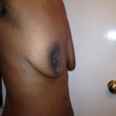 Saggy Breast Before Side Shot!