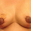 2 weeks post op