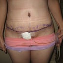 9 days post op.  they should be strippig the tape and glue next week so I can actally get everything washed of and see the incison