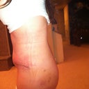 2 Weeks - Very little bruising left... You can see my swelling better here. My Dr said that the lower tummy is the last to go.