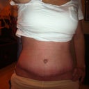 2 Weeks - Still some swelling, but not much