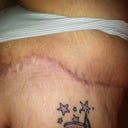Right side i used Mederma an look at my scar.I love the way my scar looks with me use n Mederma