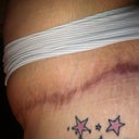 Ok now this is how my lft side looks with me use n Silicone strips..I am very disappointed ion outcome..i used for 2months and it spread out scar...