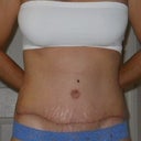 3 weeks post op - front view