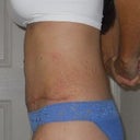 3 weeks post op - left side view