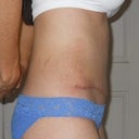 3 weeks post op - right side view