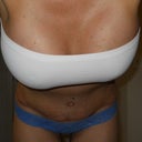 3 weeks post op - bent over front view