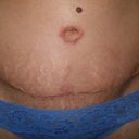 3 weeks post op - tummy tuck close up