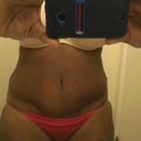 Swelling  but happy! You can still see some of the added swelling from carrying my grand baby on my hip!