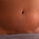 Scar at 4 months. No sign of those ugly spitting stitches.