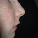 3 months after surgery. Unnatural looking bump.