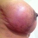 Right side and gorgeous thin scars - I feel very lucky. Thanks Mr 'O'