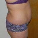 Before- Side View
