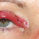 Day 1- lots of swelling and red lids