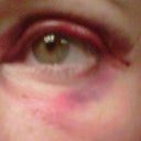 Day 3- lots of purple along my eye crease and underneath