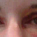 Day 5- right eye looks much better, but still a lot of bruising on the left eye
