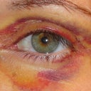 Day 8- still bruised!