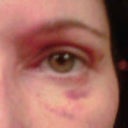 Day 11- still some bruising, but finally improving