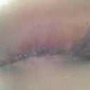 The right breast was holding up