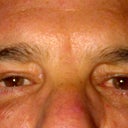 6 and a half weeks.....still slightly swollen and stitches from canthoplexy slowly disolving
