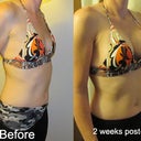 Before surgery & 2 weeks post-op