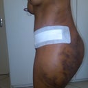 side view 4 days post op with a lot of swelling and bruising from Lipo