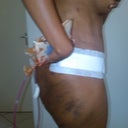 side view 4 days post op with a lot of swelling and bruising from Lipo