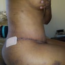 sitting view, 11 days post op