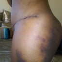 side view 11 days post swelling and bruising from Lipo is getting better.