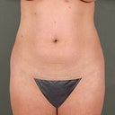 43 Year Old Female Underwent VASER Liposelection To Her Abdomen