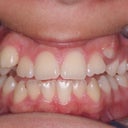 15 Year Old Female Orthodontics Without Extractions