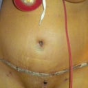 Post Op Day 4