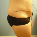 5 days post-op