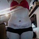 2 weeks after surgery