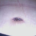 belly button close 2 weeks after surgery