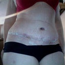 2 weeks after surgery