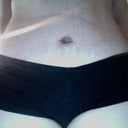 2 weeks after surgery