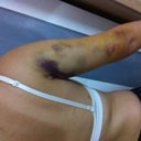 Bruising on right arm- 1 week post-op