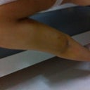 Zero bruising on left arm - 1 week post-op