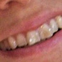 Top two front teeth were a little off, and flat, and top incisives were sticking out, overlapping a little. Overcrowding.