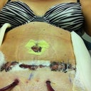 I title this picture "ZOMBIE PORN" Front view 72 hours after surgery.  Notice the drains coming out the bottom!  Look someone shaved me after all -- the mad shaver man got me!