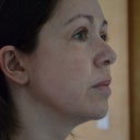 Two months post treatment, no make up.