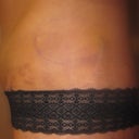 3 week PO. Left side with hematoma.