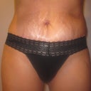 3 week PO. front view. The hematoma is still pretty swollen.