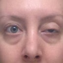 Week 2 (15 days after injections; 11 days of droop)