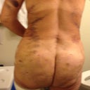 6 days post op from lipo, tt, and butt augmentation