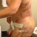 6 days post op from lipo, tt, and butt augmentation