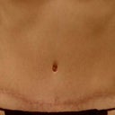 Abdominoplasty (Tummy Tuck)