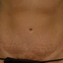 Abdominoplasty (Tummy Tuck)
