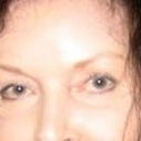 2 years after laser removal of most of tattooing. It took months of laser, and they're still not completely gone! My eyebrows still look odd and there's scarring. I have to cover leftover tattooing and scars with concealer.